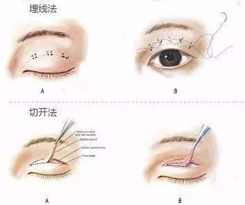 最新双眼皮技术揭秘，塑造自然美丽眼部的秘密武器